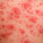 Confirma Salud de BCS segundo caso de sarampión